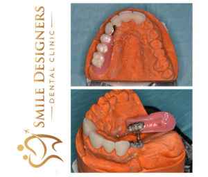 Mk1 hybrid prosthesis