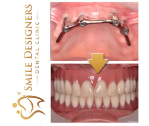 Bar-retained denture on 4 implants