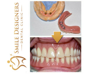 Locator-retained denture on 2 implants