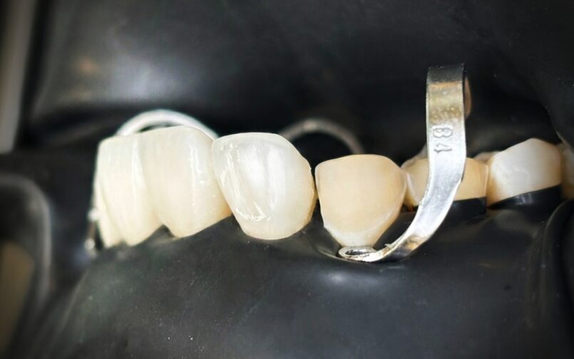 Porcelán héj vs direkt héj