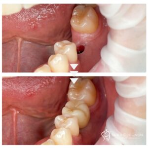 Dental implant with crown