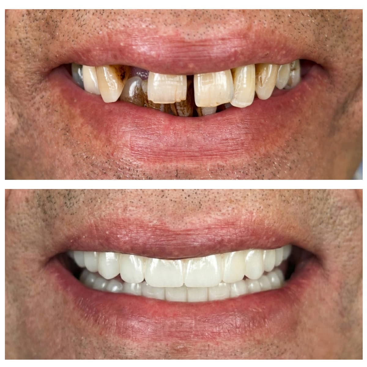 Zirconia All-on-4 fixed prosthesis before / after
