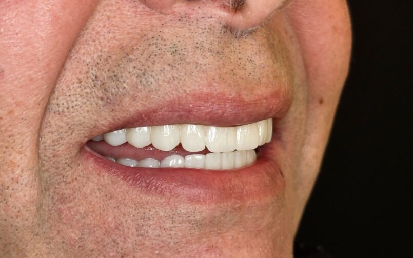 All-on-4 fix protézis monolitikus cirkonból