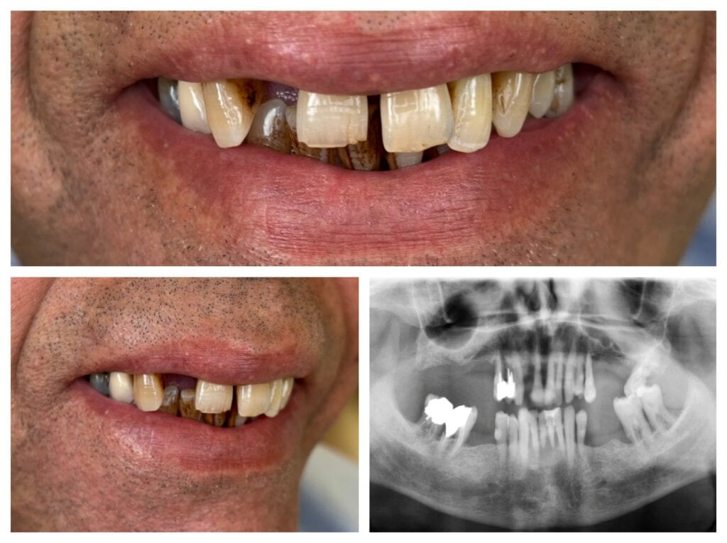 Initial state: missing teeth, periodontal disease, and decay