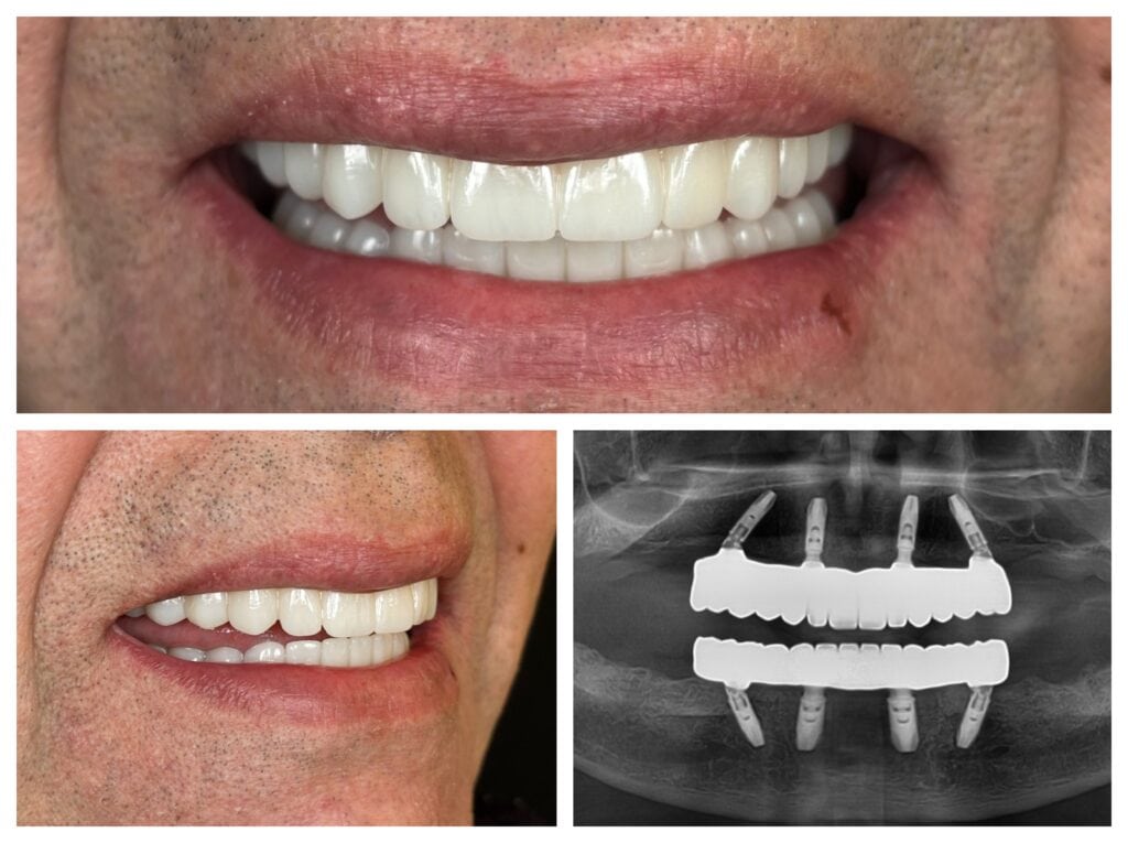 Zirconia All-on-4 fixed restoration