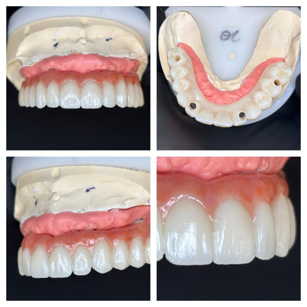 Monolithic zirconia All-on-4 prosthesis with custom ceramic artificial gum