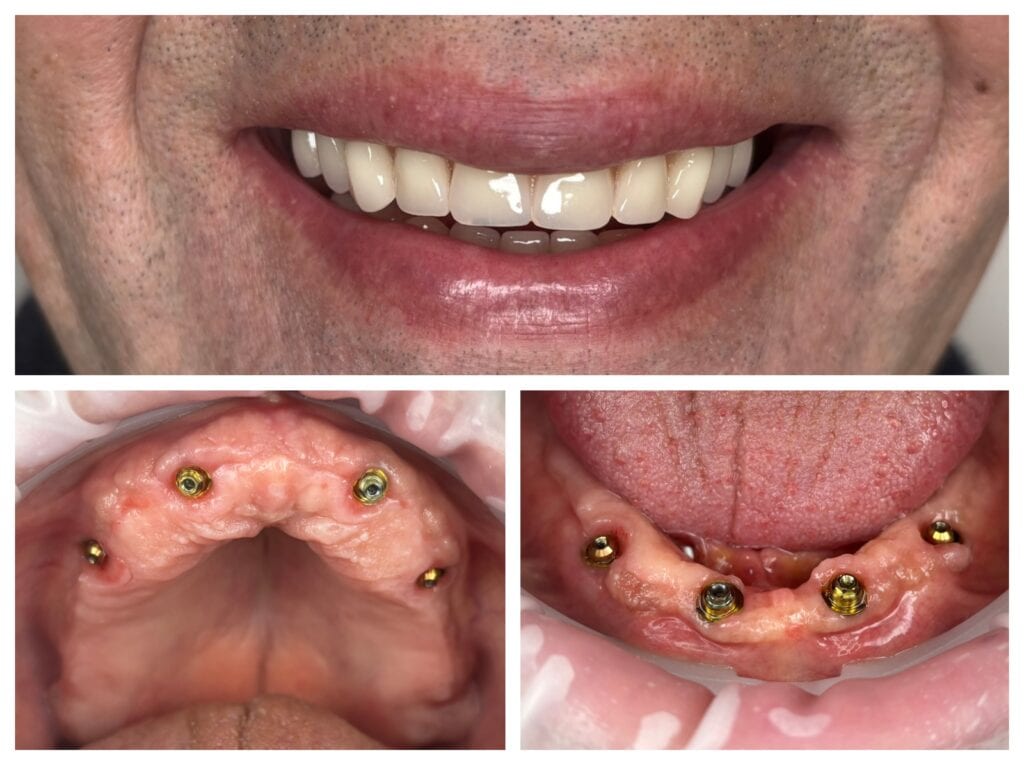 All-on-4 temporary fixed prosthesis on multi-unit abutments screwed onto implants