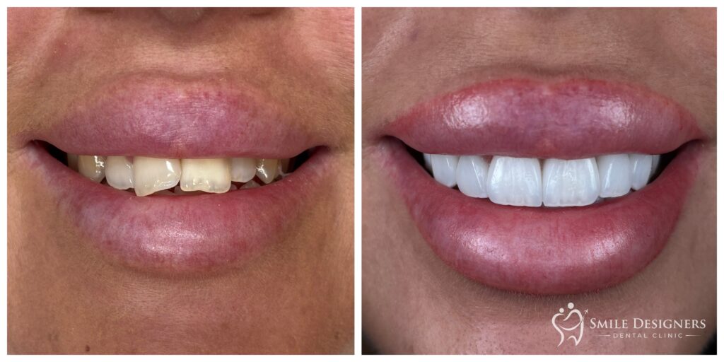 Előtte / utána: BL1 árnyalatú emax kerámia héjak