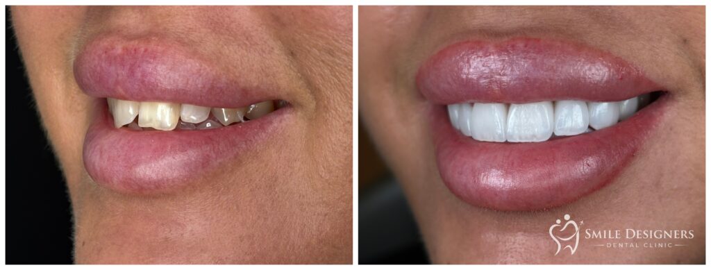 Előtte / utána: BL1 árnyalatú emax kerámia héjak