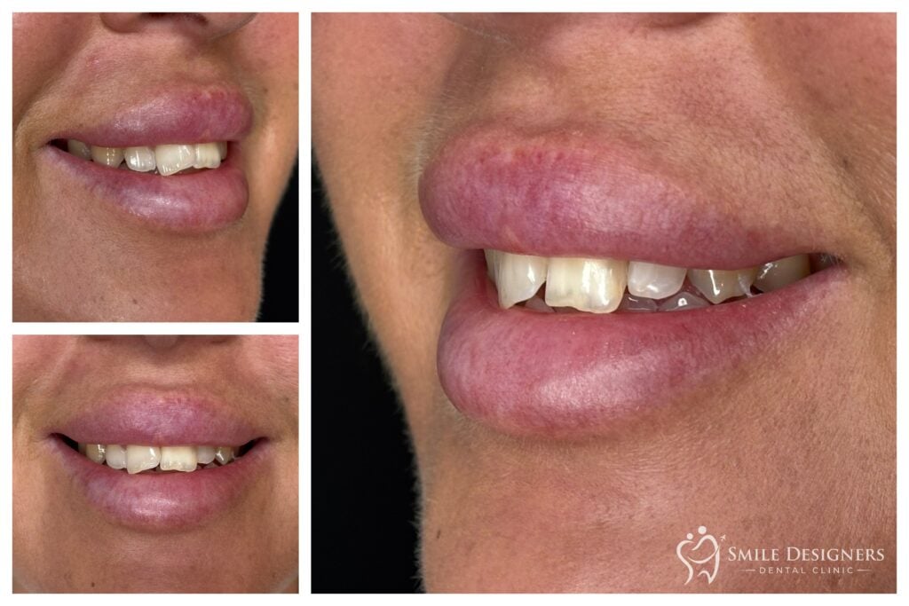 Kiindulási állapot: torlódott töredezett fogak