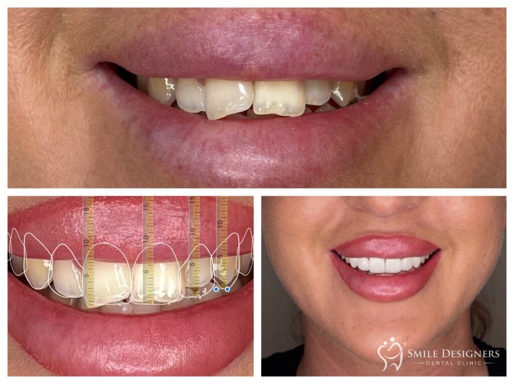 Digitális mosolytervezés