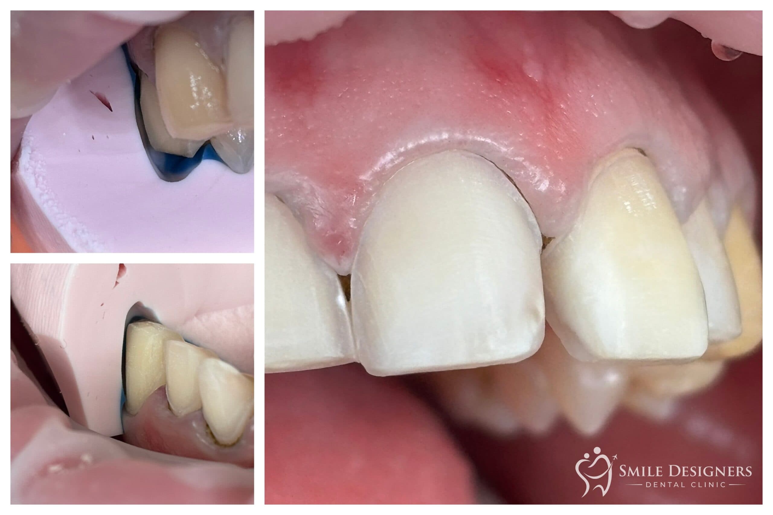 A fogak minimálinvazív lecsiszolása másolókulcsok segítségével