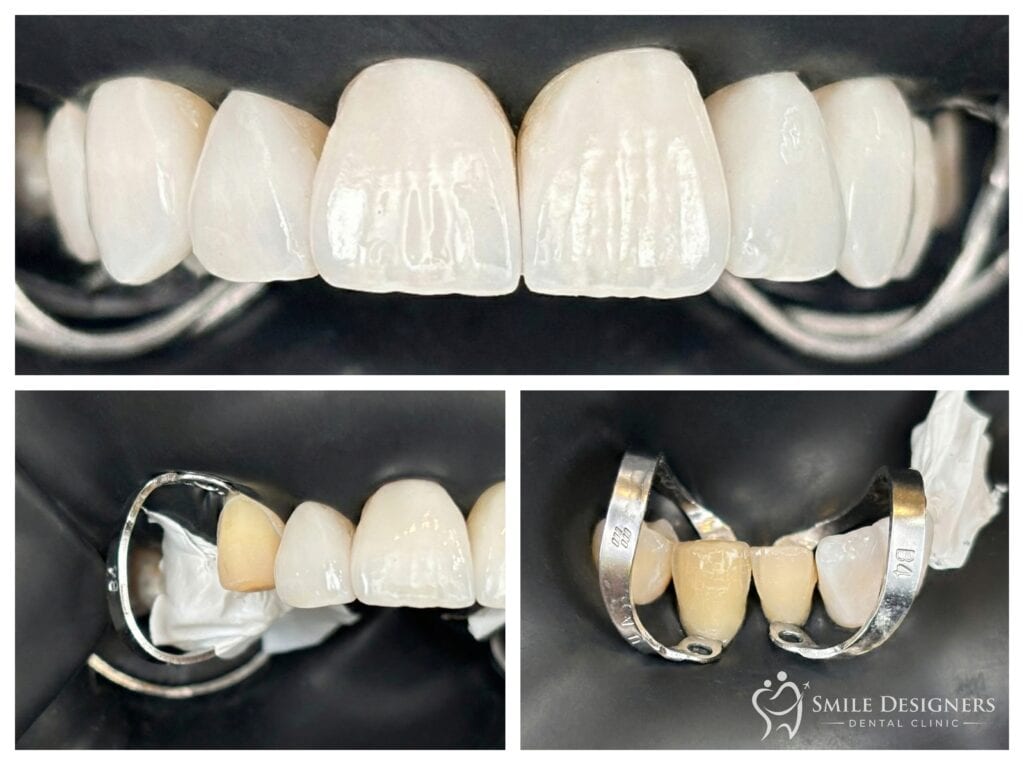 Héjak ragasztása kofferdam izolálásban