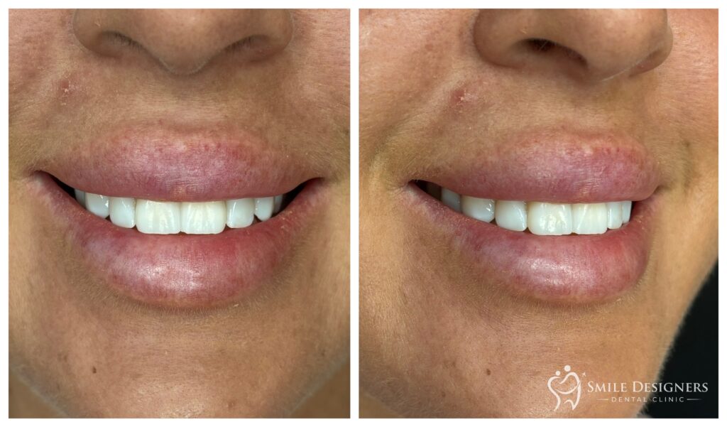 Ideiglenes héjak, akrilból