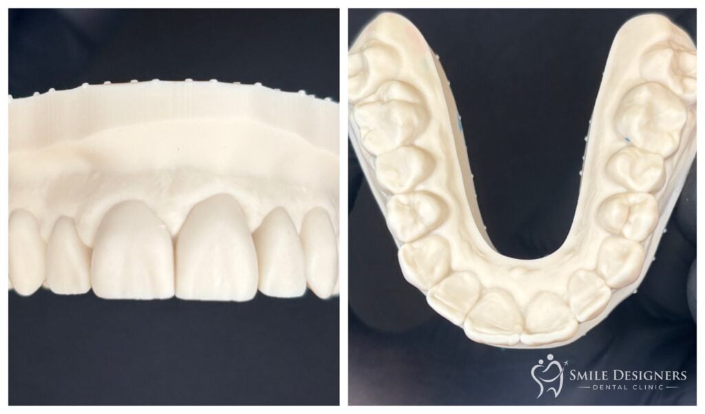 A készülő mosoly 3D modellje (Wax-up)