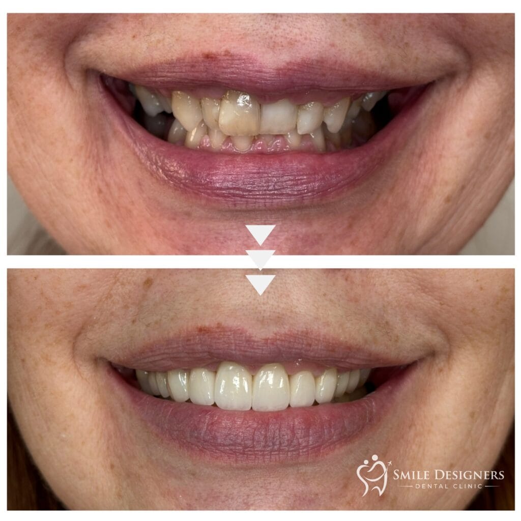 Előtte / utána: fogszabályozás és BL4 emax kerámia héjak