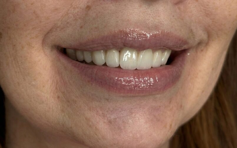 Emax kerámia héjak