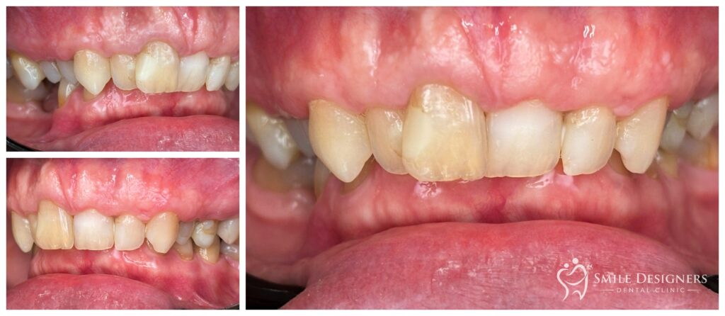 Fogszabályozás előtti állapot