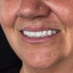 Monolitikus cirkon híd titánstég merevítéssel, Straumann implantátumokon