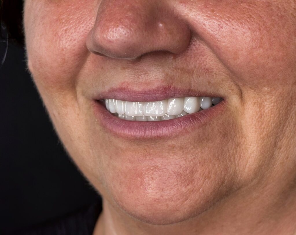 Monolitikus cirkon híd titánstég merevítéssel, Straumann implantátumokon