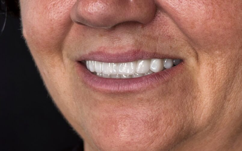 Monolitikus cirkon híd titánstég merevítéssel, Straumann implantátumokon